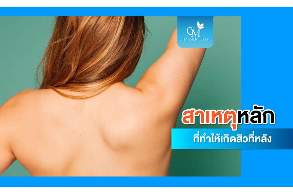 สาเหตุที่ทำให้เกิดสิวหลัง by charmer clinic