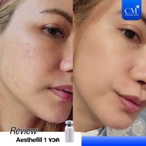 review รีวิว Aesthefill 