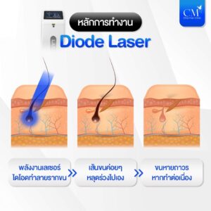 อ่านเพิ่มเติมเกี่ยวกับ Dioade Laser