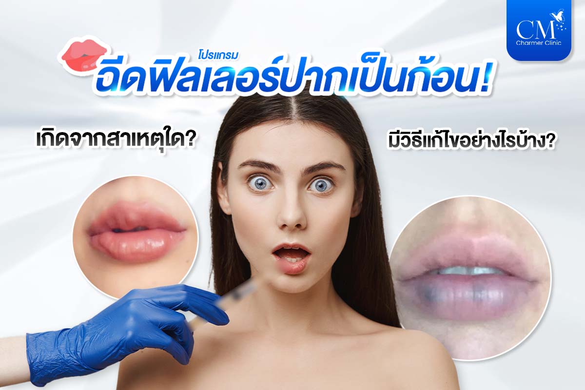 ฉีดฟิลเลอร์ปากเป็นก้อน