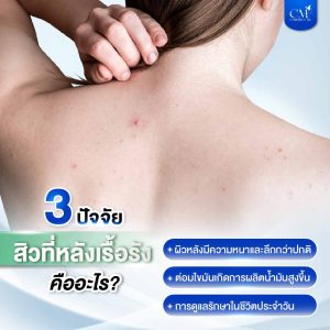 3 ปัจจัย สิวที่หลังเรื้อรัง