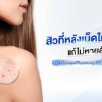 สิวที่หลัง เม็ดใหญ่