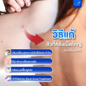 วิธีแก้ สิวที่หลัง เม็ดใหญ่