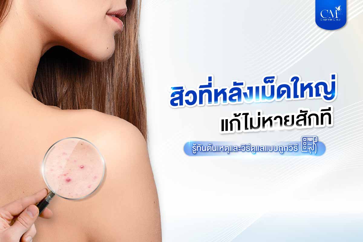 สิวที่หลัง เม็ดใหญ่