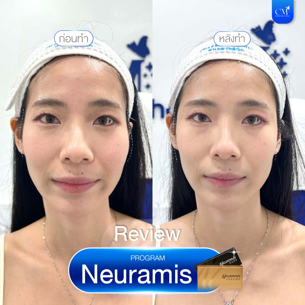 รีวิวฉีด Neuramis เติมขมับ Before After