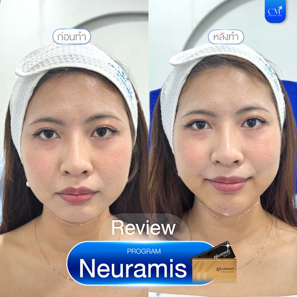 รีวิวฉีดฟิลเลอร์ Neuramis คาง Before After